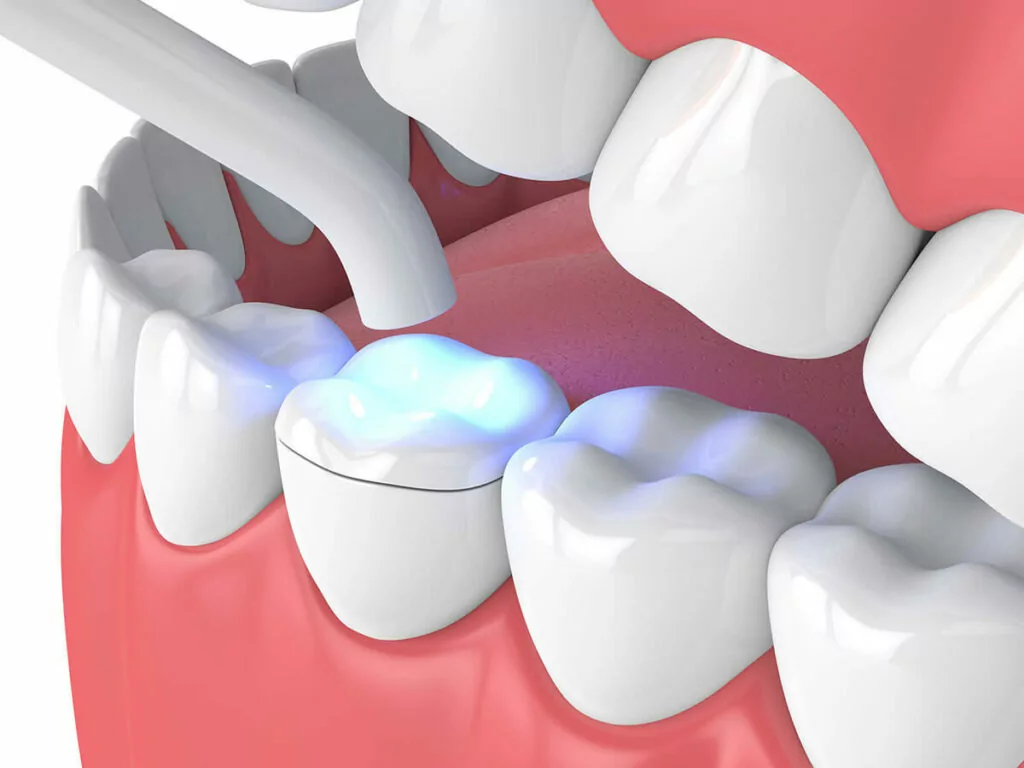dental inlay and onlay