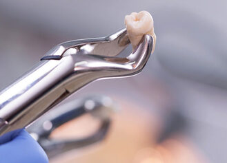 Close-up of a gloved hand holding dental forceps gripping a freshly extracted molar. The background is softly lit and blurred, suggesting a clinical setting.