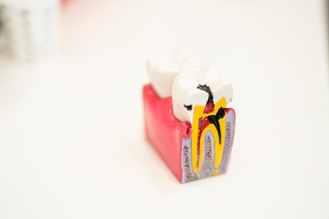 A dental model illustrates root canal treatment at Castle Family Dentistry, showing infected pulp removal and cleaning of the tooth’s inner canals.