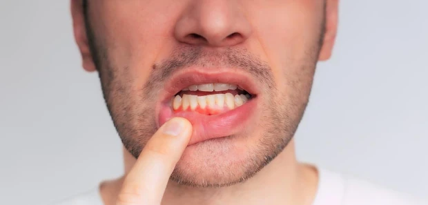 How Gum Disease Can Affect More Than Just Your Smile.